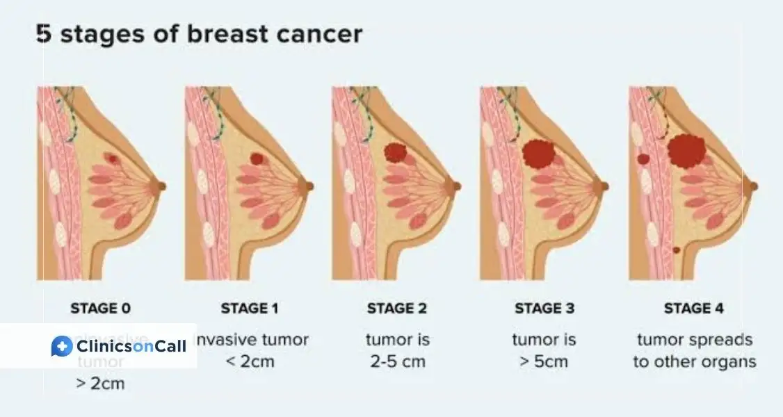 乳がんステージ3とは？症状・治療法・生存率をわかりやすく解説