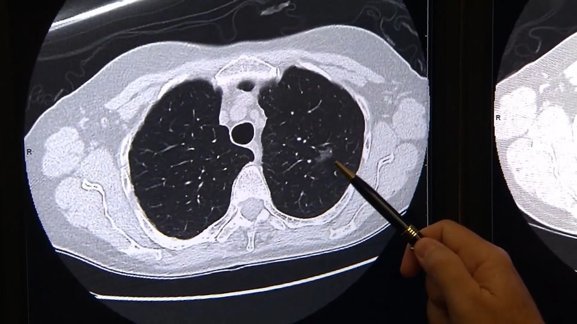 肺がん 原因を徹底解説 発症メカニズムから予防・最新治療まで完全ガイド