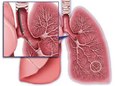 肺がん の 検査 方法を徹底解説｜早期発見のために知っておきたい最新診断ガイド