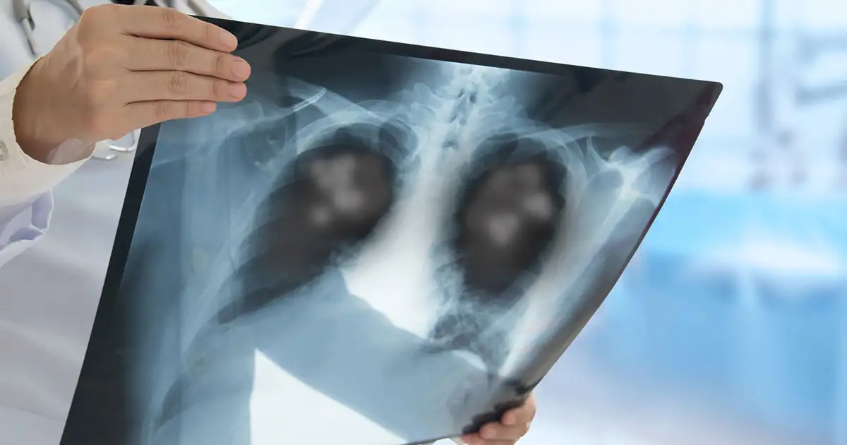 肺がん の 咳 は どんな 咳？特徴・見分け方・受診の目安まで徹底解説